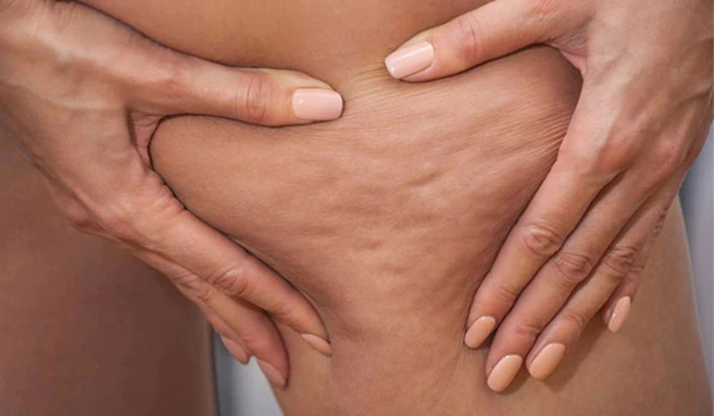 6 نکته برای اینکه سلولیت پوست شما کمتر دیده شود