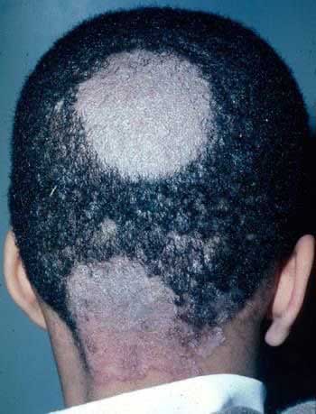 اختلالات شافت مو ( ریزش مو سکه ای )