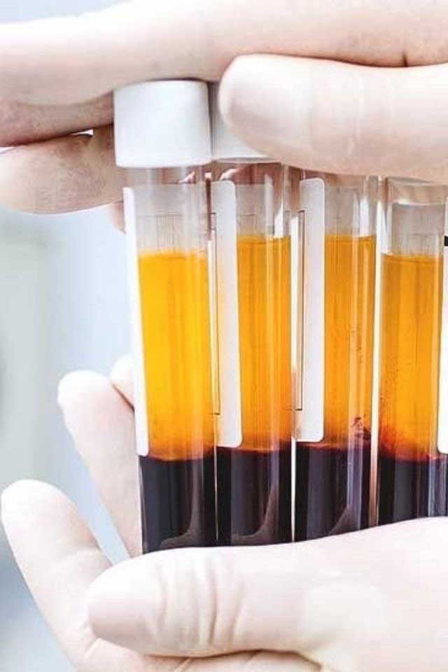 برای تولید PRP، یک متخصص پزشکی یک نمونه خون گرفته و آن را در دستگاهی به نام سانتریفیوژ قرار می دهد.