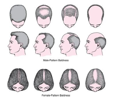 استفاده از ماینوکسیدیل در اختلالات مو از جمله درمان ریزش مو