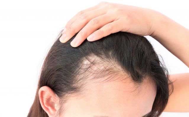 شواهد پلاسمای غنی از پلاکت برای برخی از انواع ریزش مو نسبت به سایرین قوی تر است
