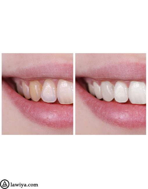 خمیر دندان سفید کننده سنسوداین مدل SanftweiB اصل انگلیس - Sensodyne SanftweiB8