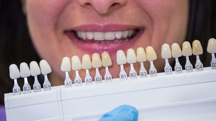 توضیح مراحل لمینت دندان